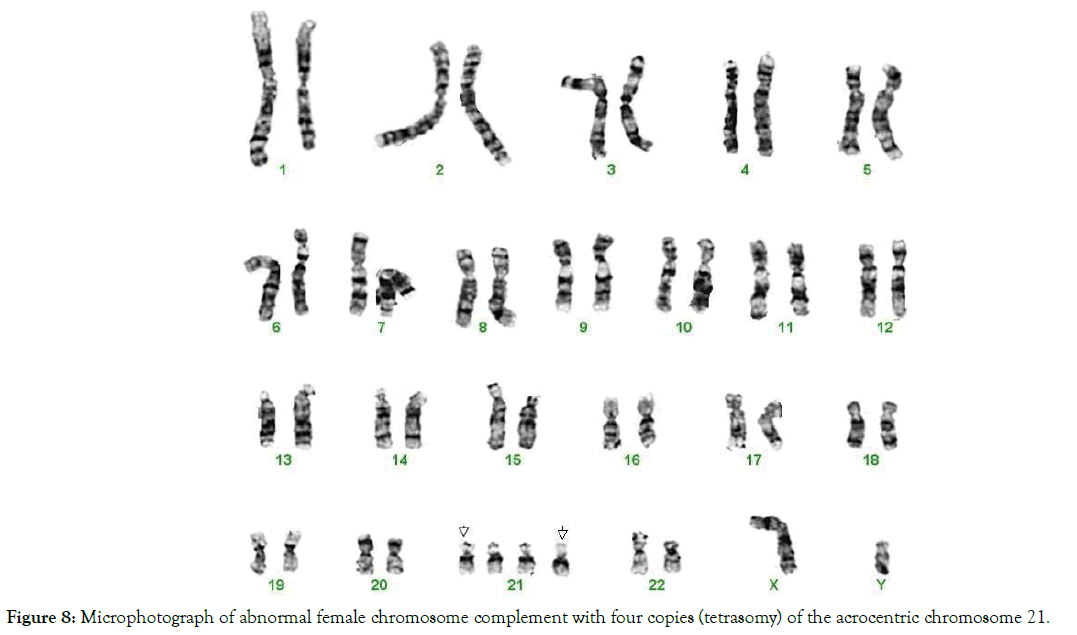 down-syndrome-tetrasomy