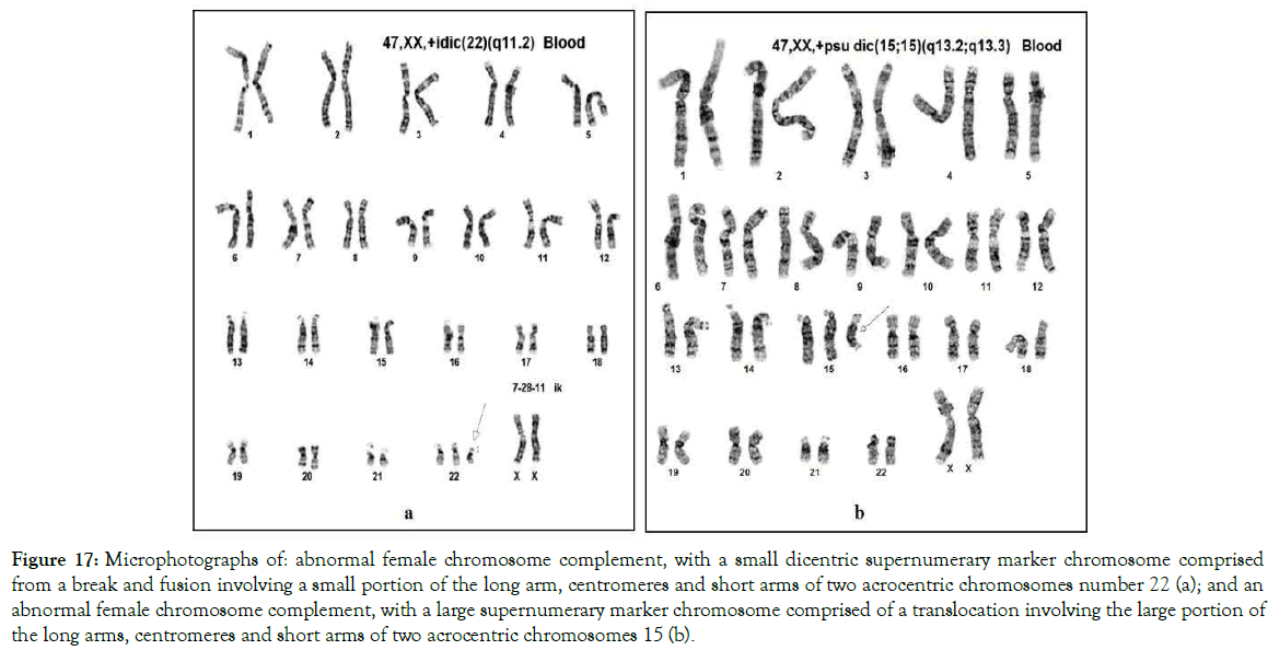 down-syndrome-translocation-involving