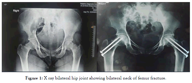endocrinology-metabolic-syndrome-bilateral-hip