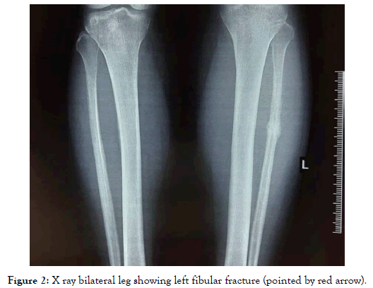 endocrinology-metabolic-syndrome-fibular-fracture