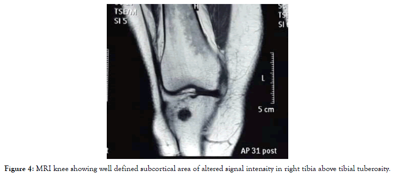 endocrinology-metabolic-syndrome-tibial-tuberosity