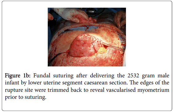 fertilization-in-vitro-Fundal-suturing