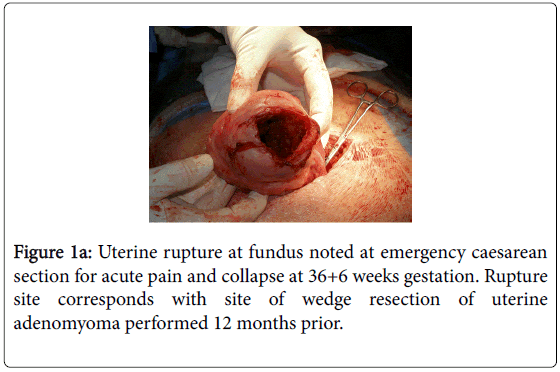 fertilization-in-vitro-Uterine-rupture