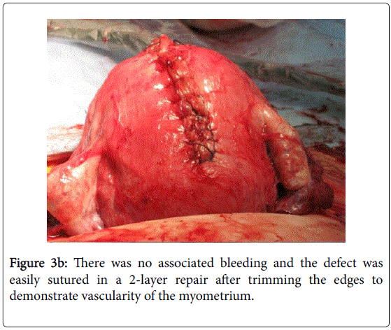 fertilization-in-vitro-associated-bleeding