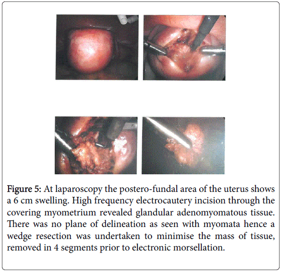 fertilization-in-vitro-electronic-morsellation