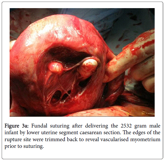 fertilization-in-vitro-lower-uterine-segment