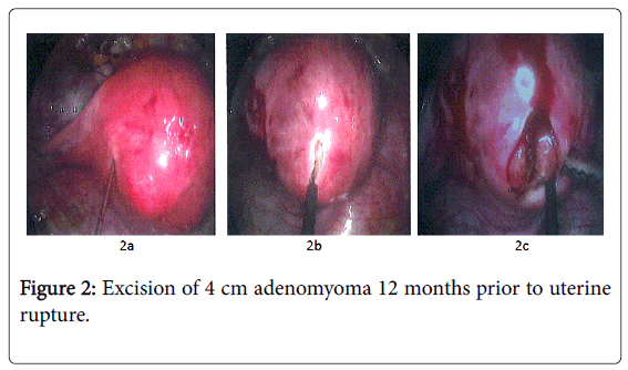 fertilization-in-vitro-prior-uterine