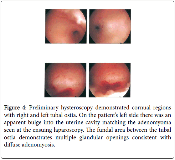 fertilization-in-vitro-uterine-cavity-matching