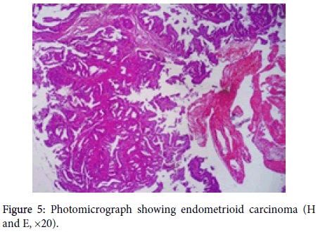 gynecology-obstetrics-endometrioid