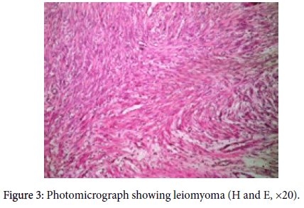 gynecology-obstetrics-leiomyoma