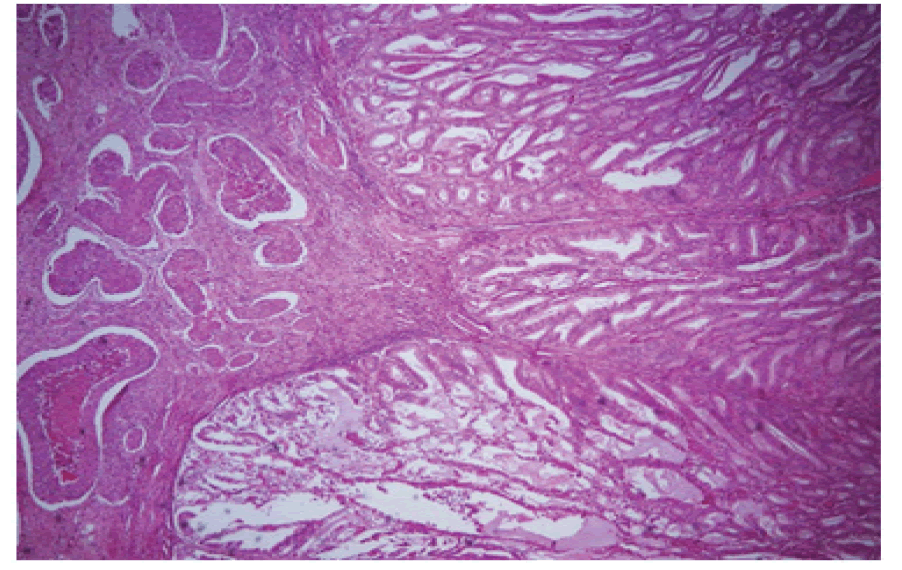 gynecology-obstetrics-ovarian-tumor