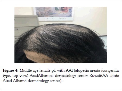 hair-therapy-alopecia