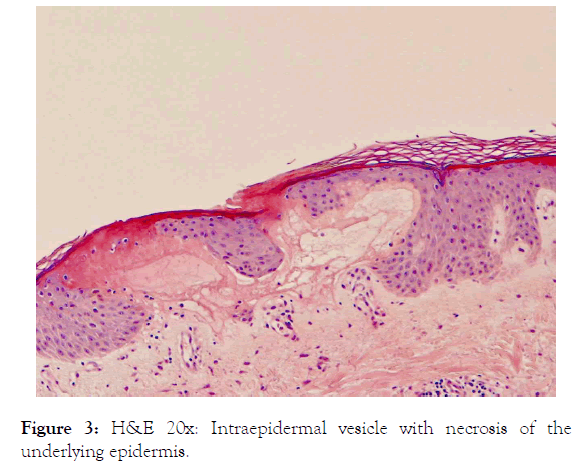 immunome-research-necrosis