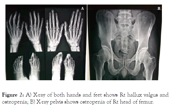 internal-medicine-hallux-valgus