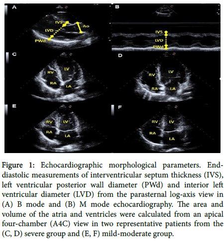 lupus-Echocardiographic