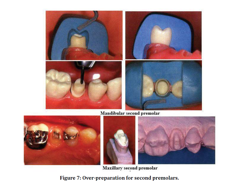 medical-dental-Over-preparation