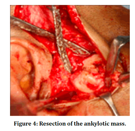 medical-dental-ankylotic-mass