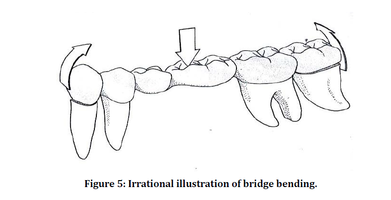 medical-dental-bridge-bending