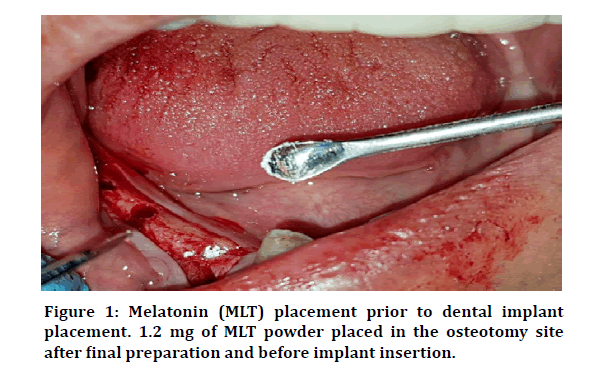 medical-dental-dental-implant