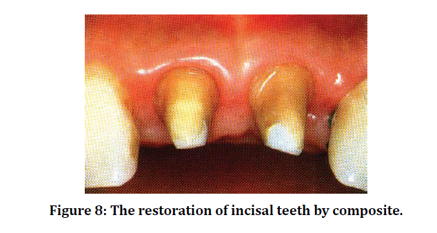 medical-dental-incisal-teeth