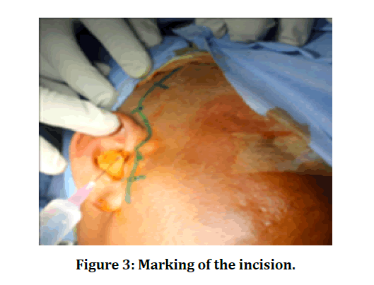 medical-dental-marking-incision