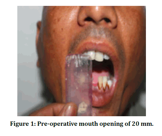 medical-dental-mouth-opening