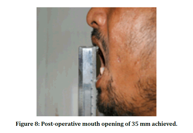 medical-dental-mouth-opening