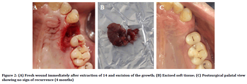 medical-dental-science-Postsurgical-palatal