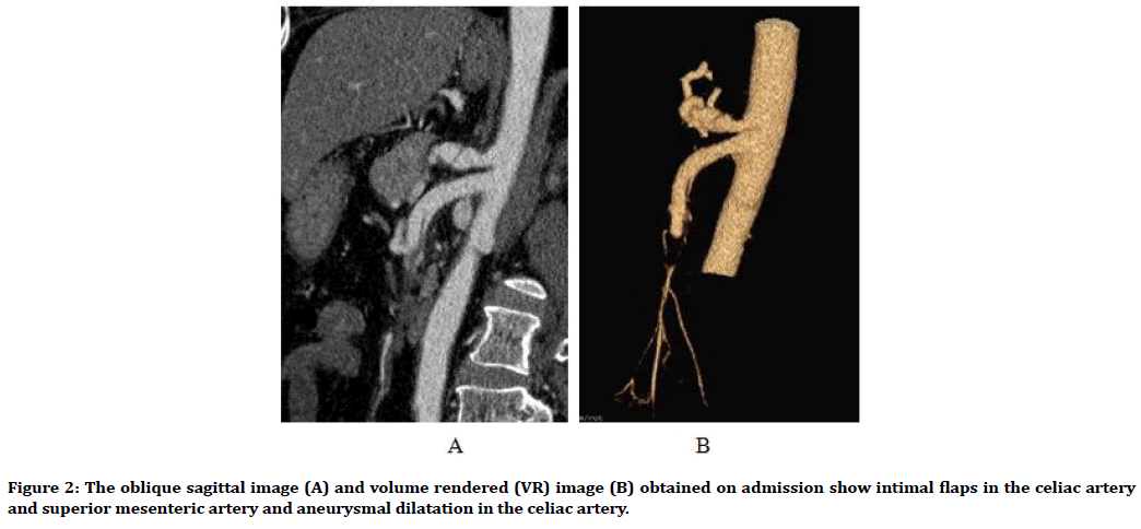 medical-dental-science-aneurysmal-dilatation