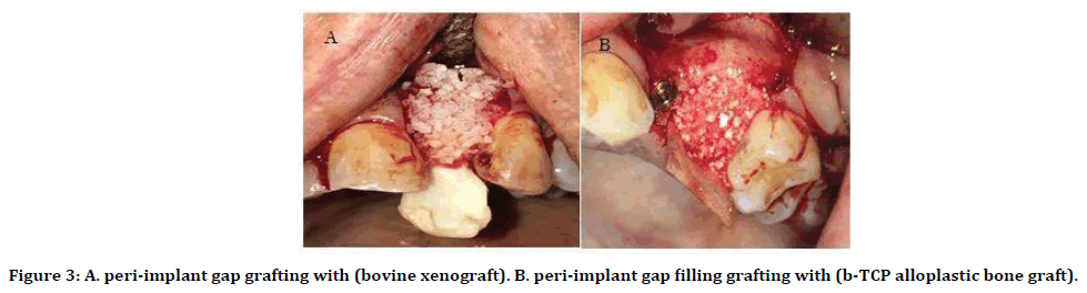 medical-dental-science-bovine-xenograft