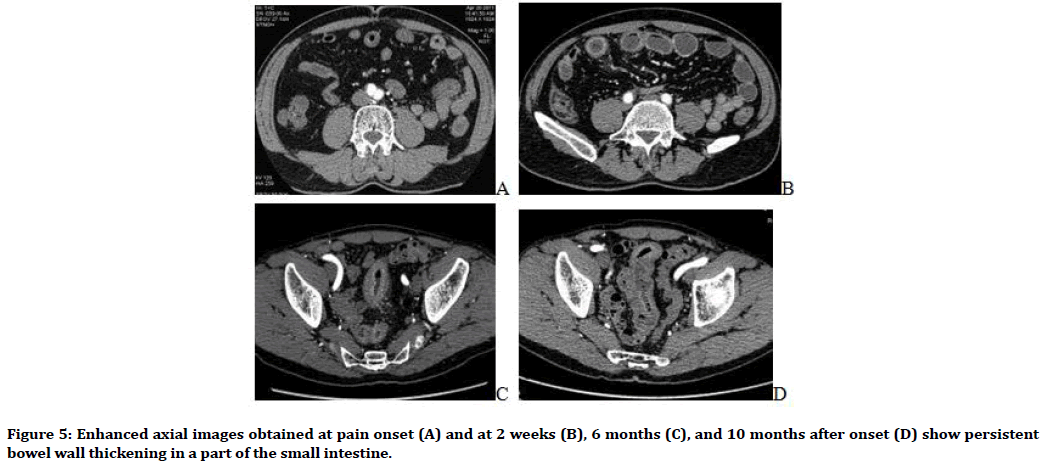 medical-dental-science-bowel-wall-thickening