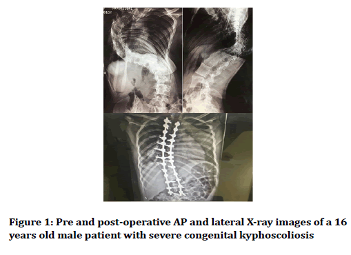 medical-dental-science-congenital-kyphoscoliosis