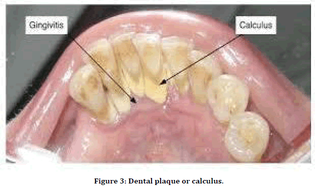 medical-dental-science-dental-plaque