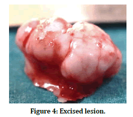 medical-dental-science-excised-lesion