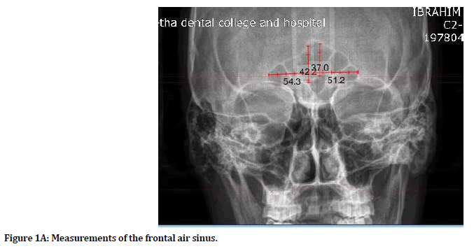 medical-dental-science-frontal-air-sinus