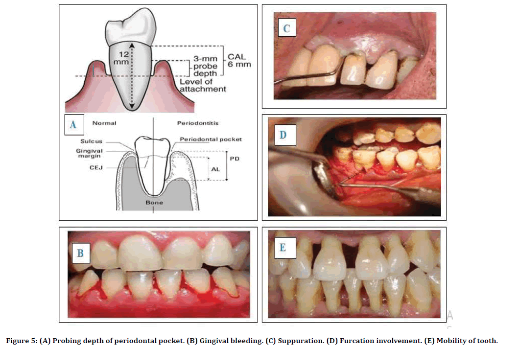 medical-dental-science-gingival-bleeding