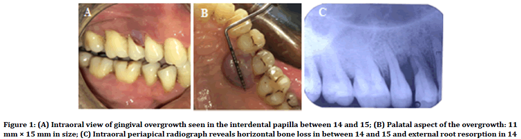 medical-dental-science-gingival-overgrowth