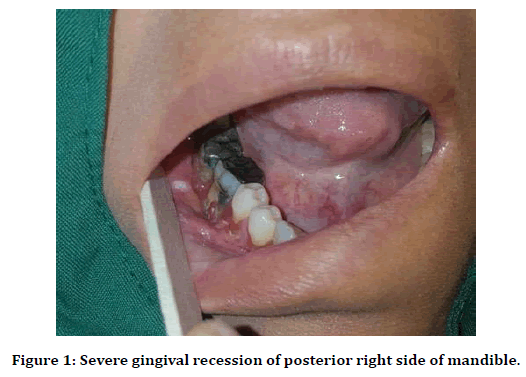 medical-dental-science-gingival-recession