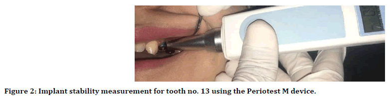 medical-dental-science-implant-stability
