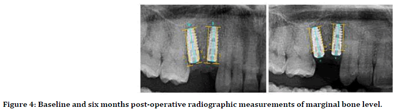 medical-dental-science-marginal-bone-level