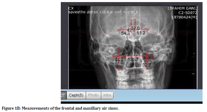 medical-dental-science-maxillary-air-sinus