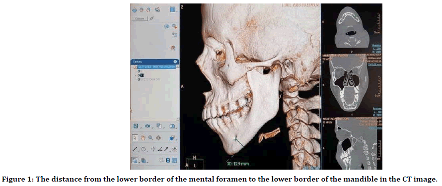 medical-dental-science-mental-foramen