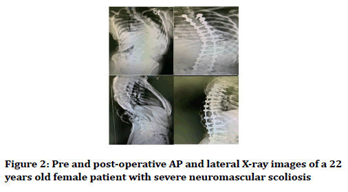 medical-dental-science-neuromascular-scoliosis