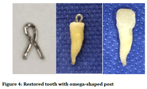 medical-dental-science-omega-shaped-post
