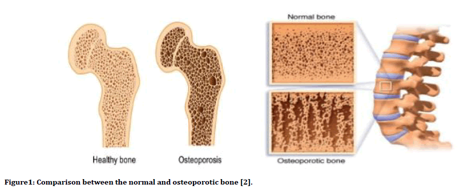 medical-dental-science-osteoporotic-bone