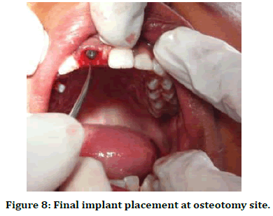 medical-dental-science-osteotomy-site