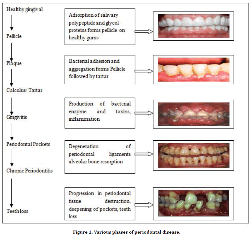 types of periodontal disease Medical pictures info – periodontal ...