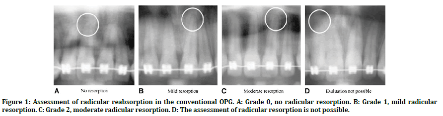 medical-dental-science-radicular-reabsorption