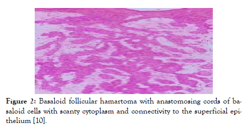 medical-diagnostic-methods-hamartoma