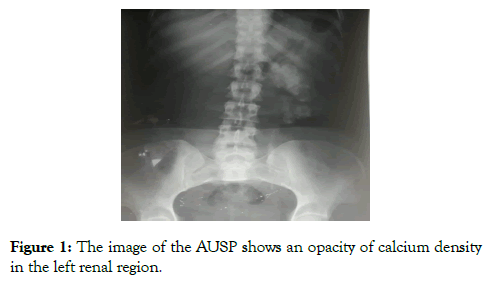 medical-surgical-urology-calcium